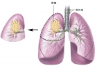 人参皂苷rh2减轻肺癌放化疗毒副作用